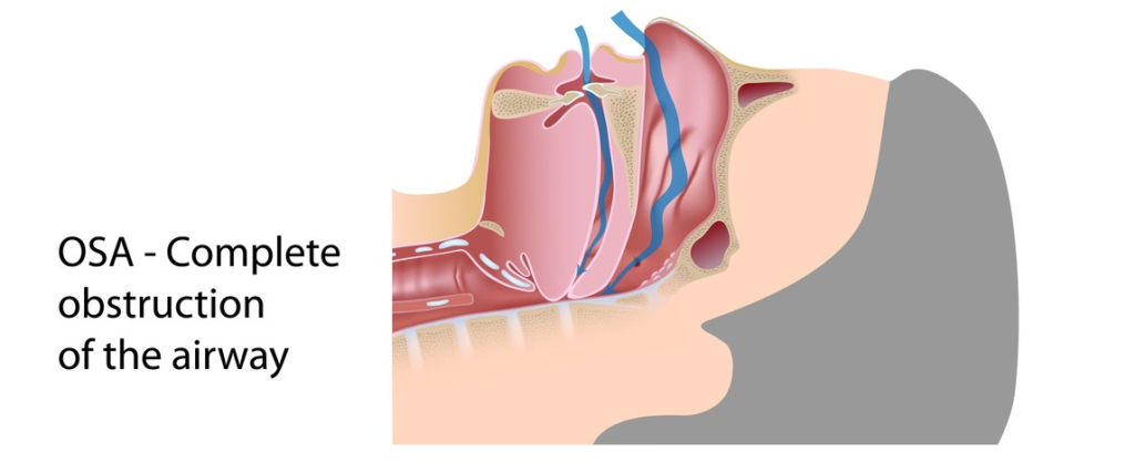 Sleep Apnea – Advanced Sleep